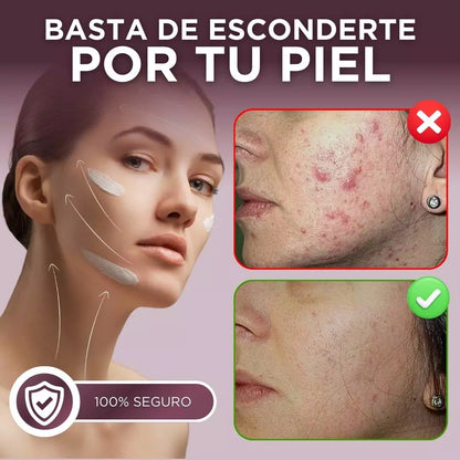 Kit Acné, Détox, Cicatrices, Poros Dilatados (BL1 Beauclean + BL2)